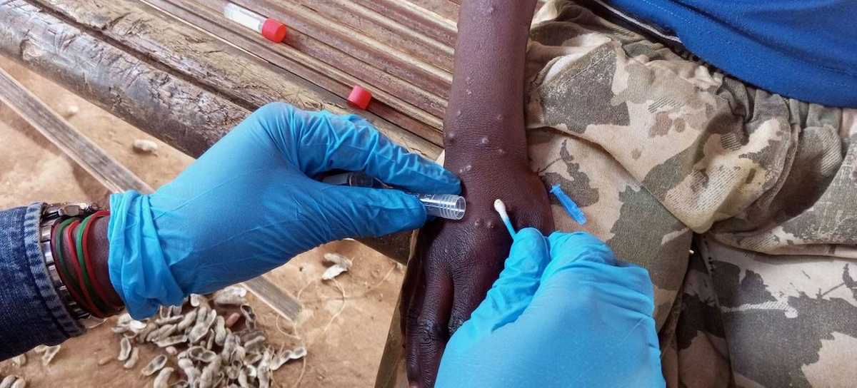 Un trabajador sanitario toma una muestra de una persona con mpox. | Foto: OMS/Katson Maliro