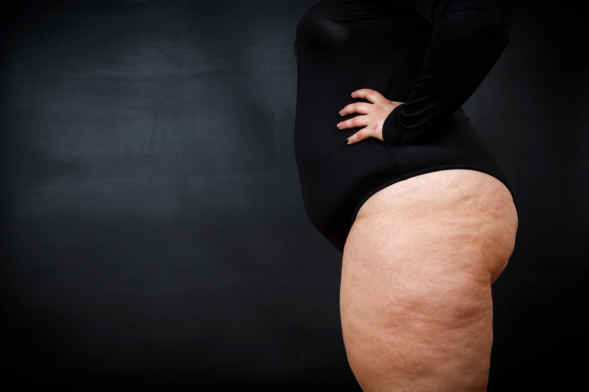 Lipedema