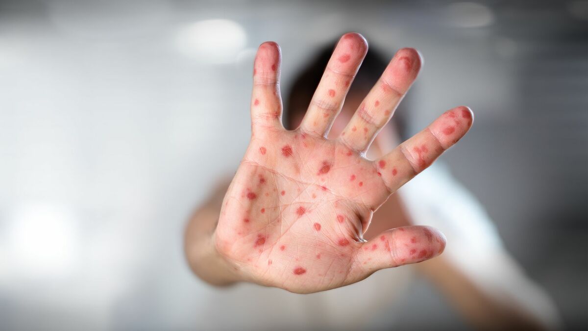 La viruela del mono, ¿culebrón del verano o nueva edición de pandemia del miedo?