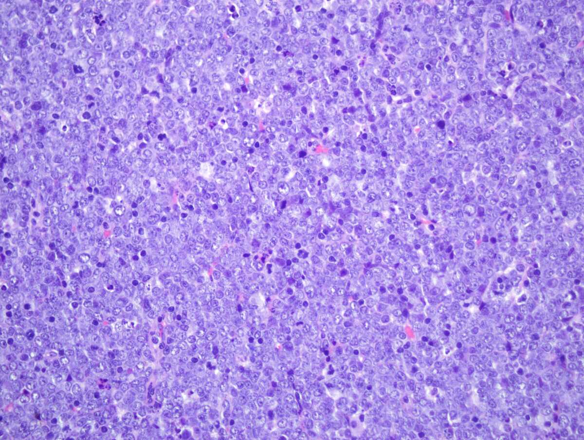 histología de un nódulo linfático de un ratón con leucemia (B-ALL). CIC